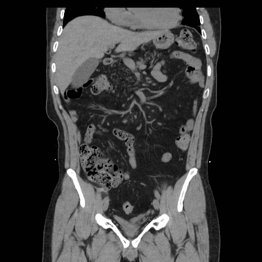 File:Colocutaneous fistula in Crohn's disease (Radiopaedia 29586-30093 Coronal non-contrast 10).jpg