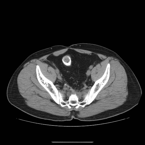 File:Colocutaneous fistula in Crohn's disease (Radiopaedia 29586-30093 D 31).jpg