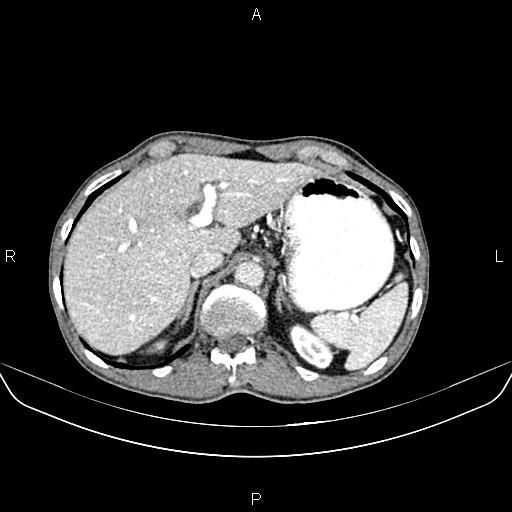 File:Colon adenocarcinoma - hepatic flexure (Radiopaedia 85635-101395 A 21).jpg