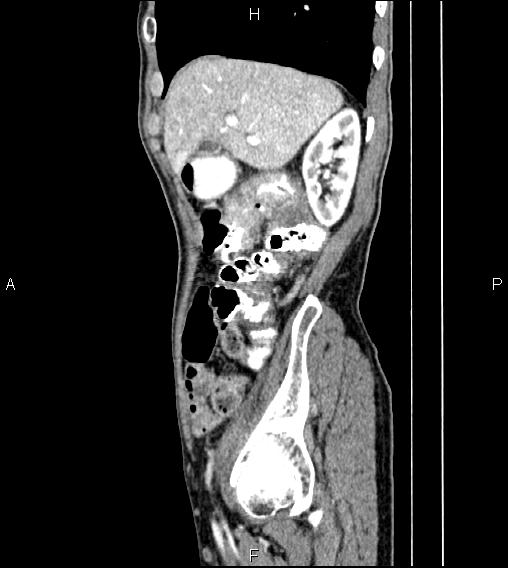 Colon adenocarcinoma - hepatic flexure (Radiopaedia 85635-101395 D 21).jpg