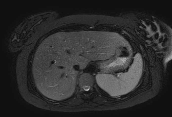File:Colon adenocarcinoma with Krukenberg tumors, advanced pregnancy (Radiopaedia 67279-76645 Axial T2 SPAIR 71).jpg