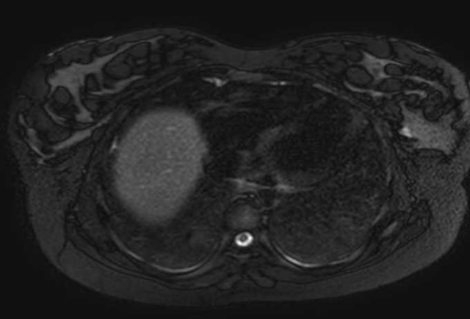 Colon adenocarcinoma with Krukenberg tumors, advanced pregnancy (Radiopaedia 67279-76645 Axial T2 SPAIR 82).jpg