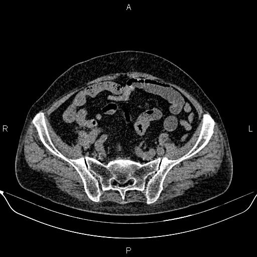 File:Colon cancer (Radiopaedia 90215-107432 Axial non-contrast 69).jpg