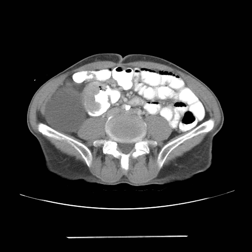File:Colon cancer with calcified liver metastasis (Radiopaedia 74423-85307 A 47).jpg