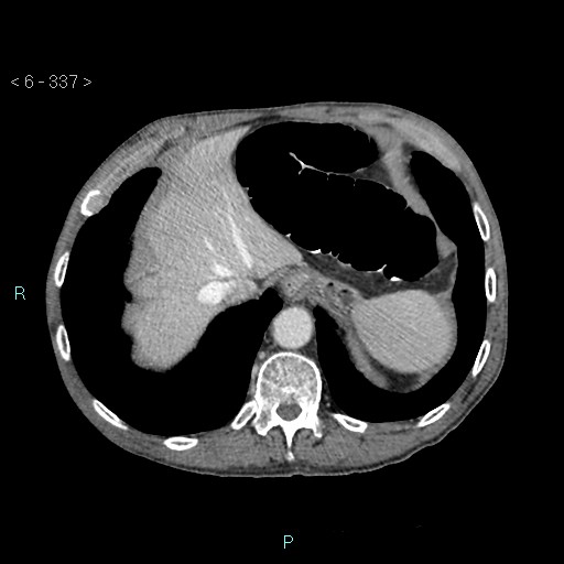 File:Colonic cancer (ultrasound and TC imaging) (Radiopaedia 50346-55713 B 337).jpg