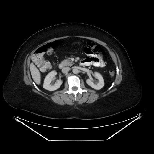File:Colonic intussusception due to adenocarcinoma (Radiopaedia 86828-102987 A 61).jpg