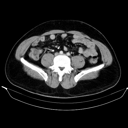 Colonic lipoma with colo-colic intussusception (Radiopaedia 58944-66200 A 43).jpg
