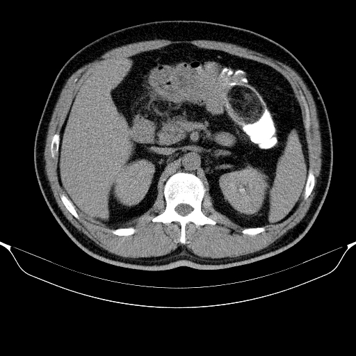 Colonic lipoma with colo-colic intussusception (Radiopaedia 58944-66200 Axial C+ rectal 17).jpg