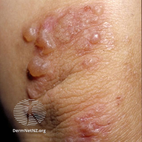 File:Dermatitis herpetiformis (DermNet NZ immune-s-dh4).jpg