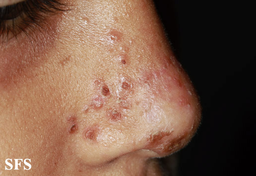 File:Impetigo (Dermatology Atlas 73).jpg
