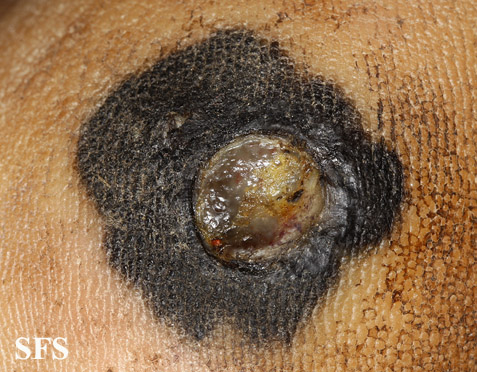 File:Melanoma (Dermatology Atlas 40).jpg