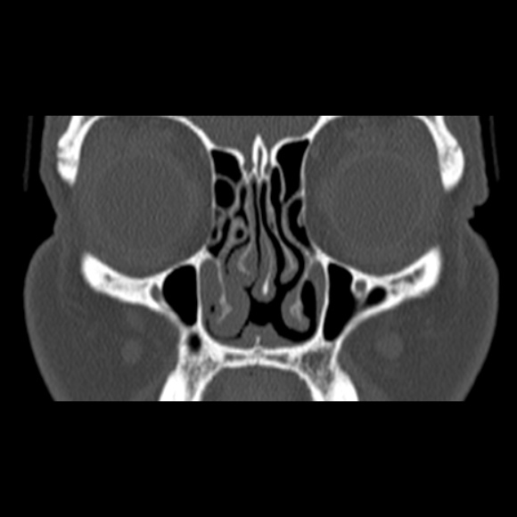 Nasal septal perforation (Radiopaedia 25030-25289 Coronal bone window 25).jpg
