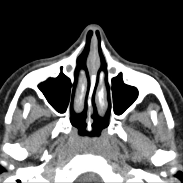 Nasolabial cyst (Radiopaedia 33987-35205 Axial non-contrast 21).jpg