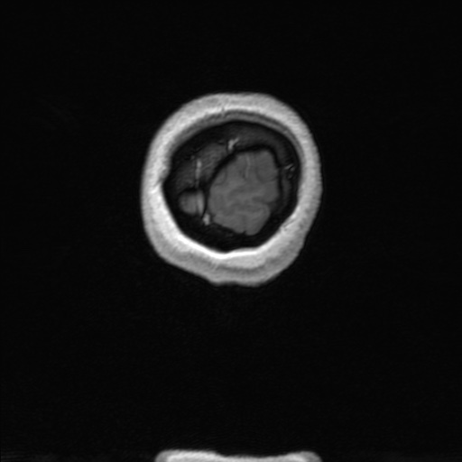 Nasopharyngeal carcinoma (T1 N3a) with complete response (Radiopaedia 61357-69619 Coronal 3D volume 189).jpg