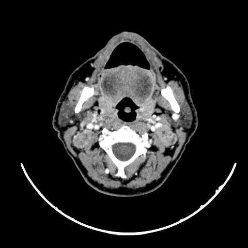 File:Nasopharyngeal carcinoma - infiltrating the clivus (Radiopaedia 62583-70875 Axial Post contrast 29).jpg