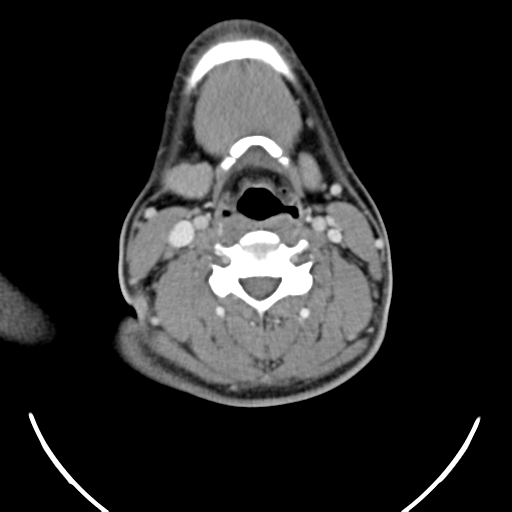 File:Nasopharyngeal carcinoma with pterygopalatine fossa involvement (Radiopaedia 33102-34132 A 37).png