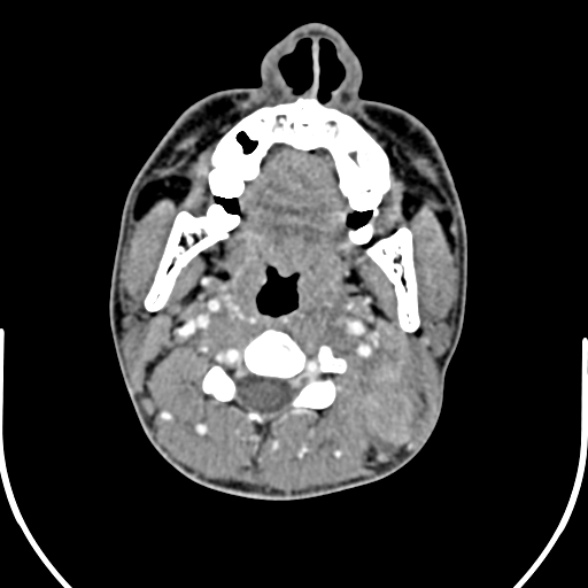 Nasopharyngeal carcinoma with skull base invasion (Radiopaedia 53415-59705 A 90).jpg