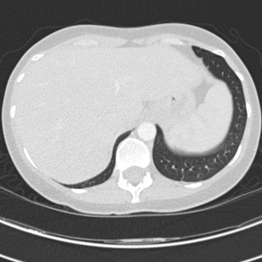 File:Necrobiotic pulmonary nodules - Crohn disease (Radiopaedia 20723-20631 Axial lung window 128).jpg