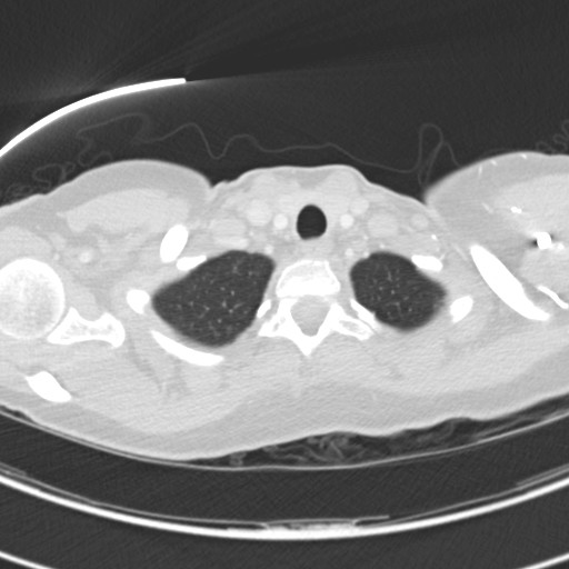 Necrobiotic pulmonary nodules - Crohn disease (Radiopaedia 20723-20631 Axial lung window 13).jpg