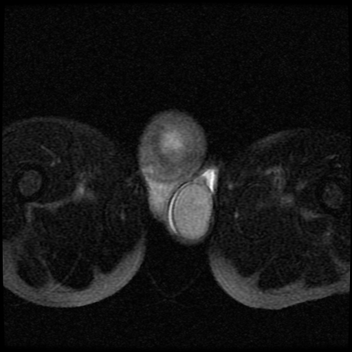 File:Necrotizing epididymo-orchitis with intra-testicular abscess (Radiopaedia 29397-29860 Axial T2 fat sat 16).jpg