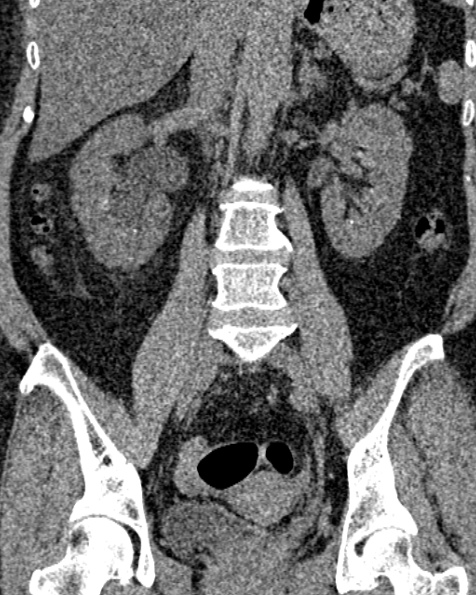 File:Nephrostomy for urosepsis (Radiopaedia 26180-26330 non-contrast 53).jpg