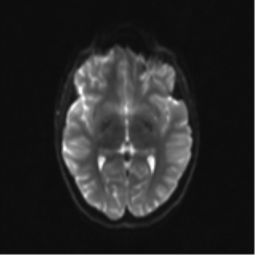 Neurenteric cyst (Radiopaedia 58641-65837 Axial DWI 18).png