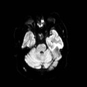 File:Neuro-Behcet's disease (Radiopaedia 21557-21506 Axial DWI 9).jpg