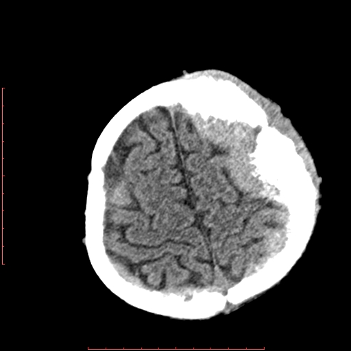 File:Neuroblastoma skull metastasis (Radiopaedia 56053-62683 Axial non-contrast 14).jpg