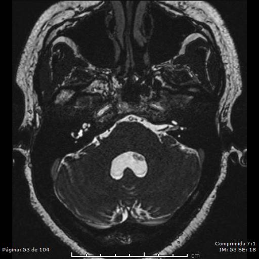 Neurocysticercosis (Radiopaedia 58636-65832 I 53).jpg