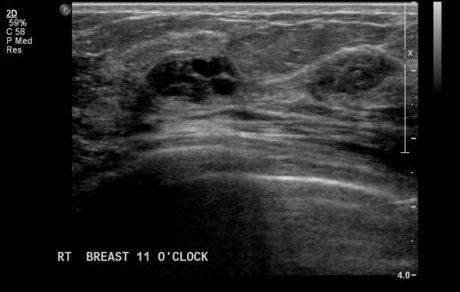 File:Neurofibromatosis of breast (Radiopaedia 5921-7462 H 1).jpg