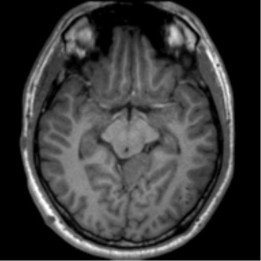 File:Neurofibromatosis type 2 (Radiopaedia 44936-48838 Axial T1 59).png