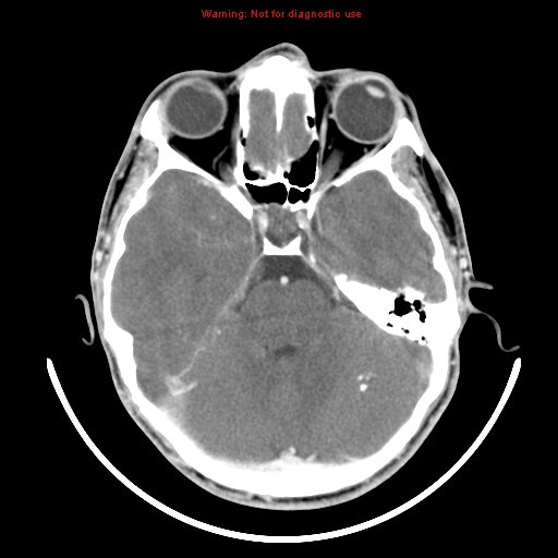 File:Neurofibromatosis type 2 (Radiopaedia 8953-9732 C 10).jpg