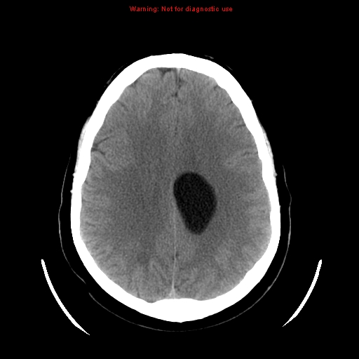 File:Neuroglial cyst (Radiopaedia 10713-11185 Axial non-contrast 12).jpg