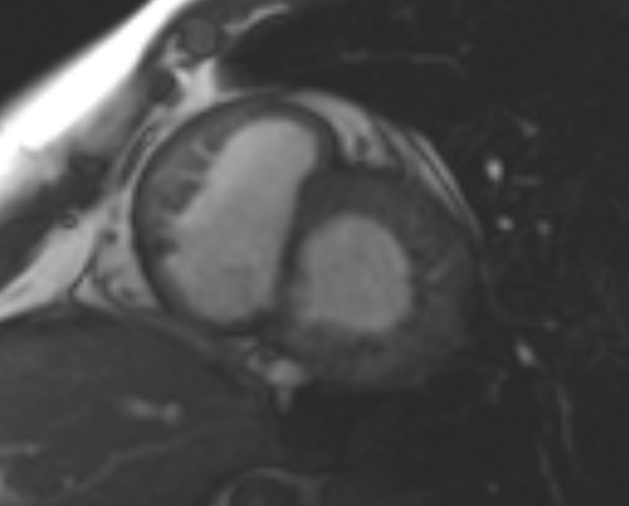File:Non-compaction of the left ventricle (Radiopaedia 69436-79314 Short axis cine 149).jpg