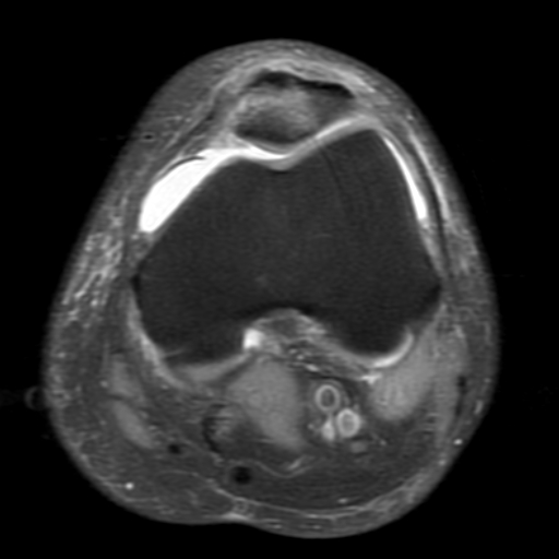 File:Non-displaced patella fracture (Radiopaedia 15932-15582 Axial PD fat sat 9).jpg