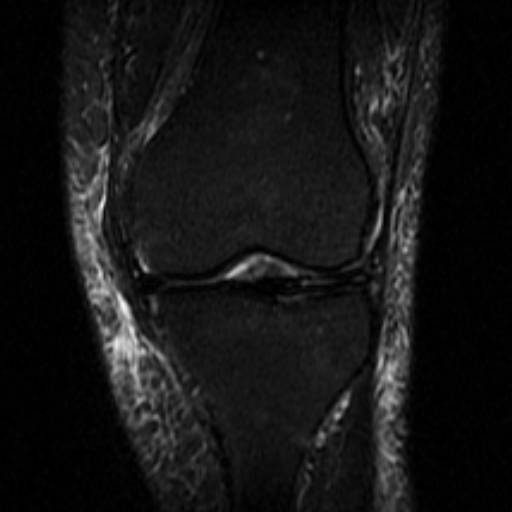 File:Non-displaced patella fracture (Radiopaedia 15932-15582 Coronal STIR 11).jpg