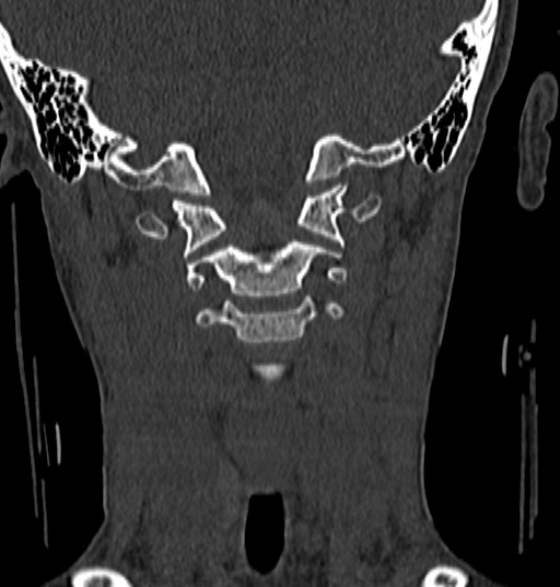 File:Normal CT cervical spine - 12-year-old (Radiopaedia 55352-61775 Coronal bone window 77).jpg