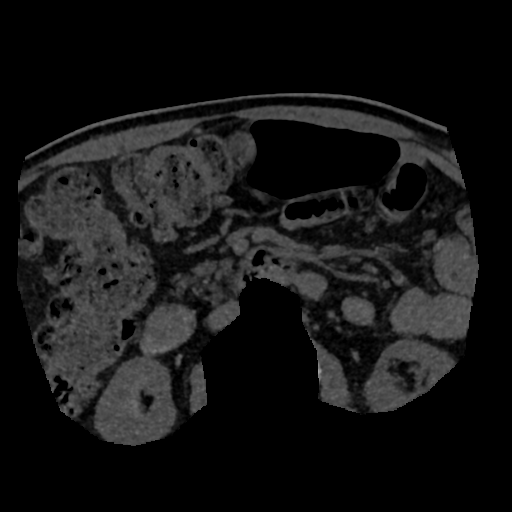 File:Normal CT intravenous cholangiogram (Radiopaedia 38199-40208 Axial IVC (MIP) 5).png