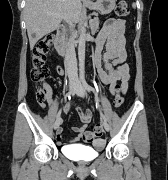 Normal CT intravenous urogram (Radiopaedia 39444-41759 A 258).jpg