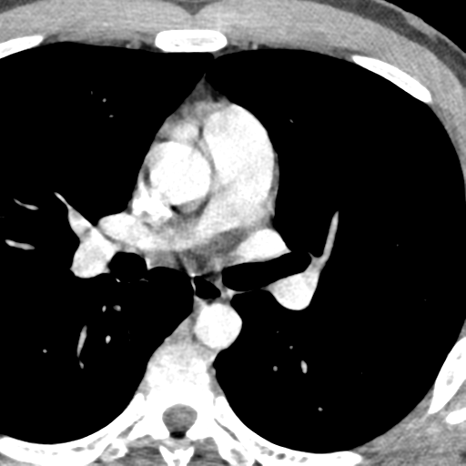 File:Normal CT pulmonary veins (pre RF ablation) (Radiopaedia 41748-44702 A 95).png