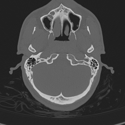 Normal CT skull (Radiopaedia 40798-43459 A 23).png
