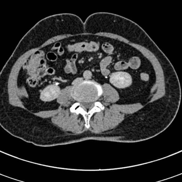 File:Normal CT split bolus study of the renal tract (Radiopaedia 48631-53634 Axial split bolus 147).jpg