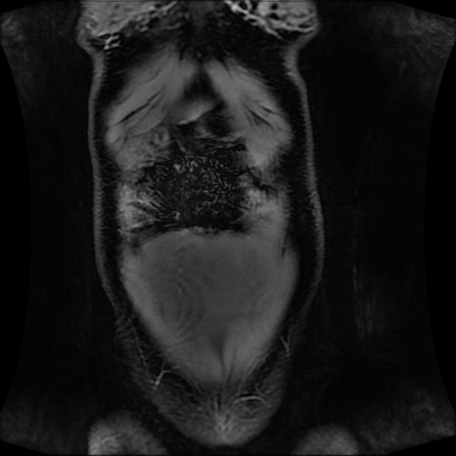 Normal MRI abdomen in pregnancy (Radiopaedia 88001-104541 M 31).jpg
