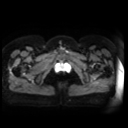 Normal MRI abdomen in pregnancy (Radiopaedia 88005-104548 Axial DWI 7).jpg