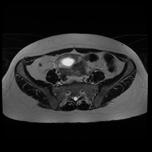 Normal MRI abdomen in pregnancy (Radiopaedia 88005-104548 Axial T2 18).jpg
