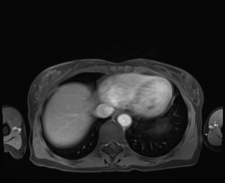 Normal adrenal glands MRI (Radiopaedia 82017-96004 M 8).jpg