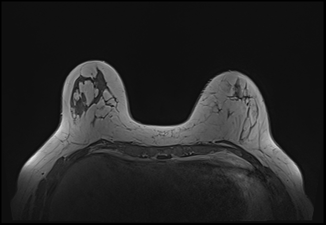 File:Normal breast MRI - dense breasts (Radiopaedia 80454-93850 Axial T1 58).jpg