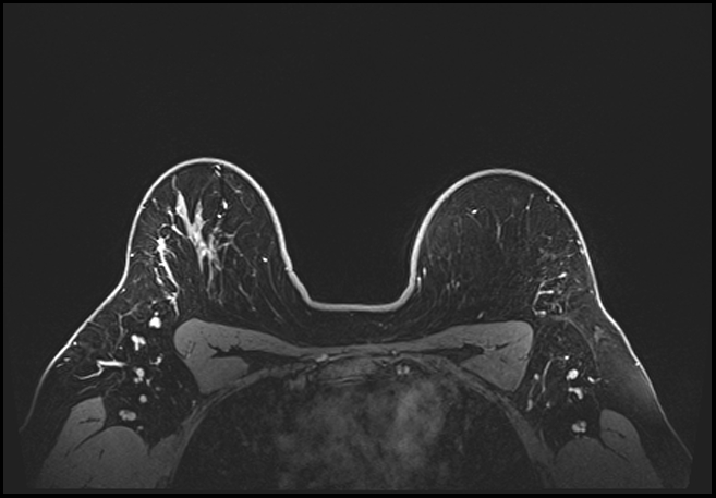Normal breast MRI - dense breasts (Radiopaedia 80454-93850 C 174).jpg