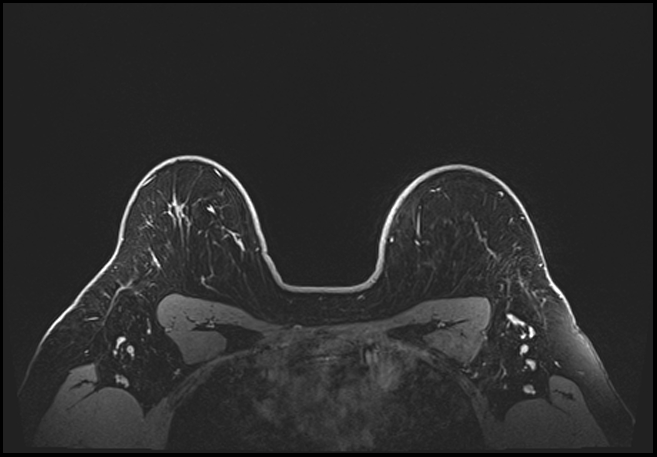 Normal breast MRI - dense breasts (Radiopaedia 80454-93850 C 182).jpg