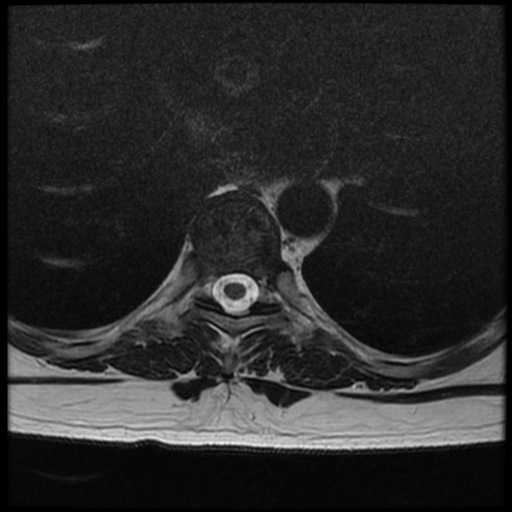 File:Normal cervical and thoracic spine MRI (Radiopaedia 35630-37156 H 21).png